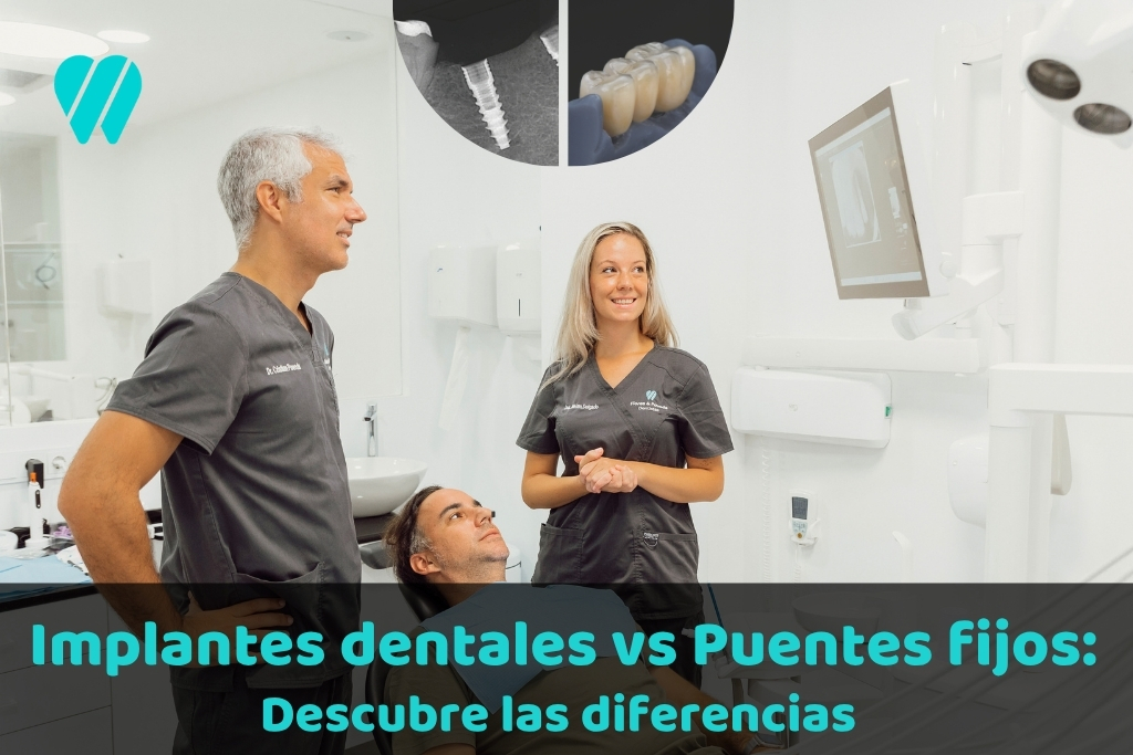 Implantes Dentales vs Puentes Fijos: Descubre las diferencias