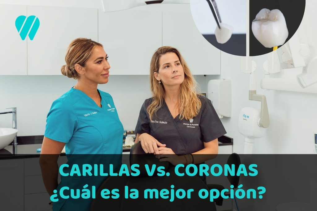 Carillas dentales vs Coronas: ¿Cuál es la mejor opción para tu sonrisa?